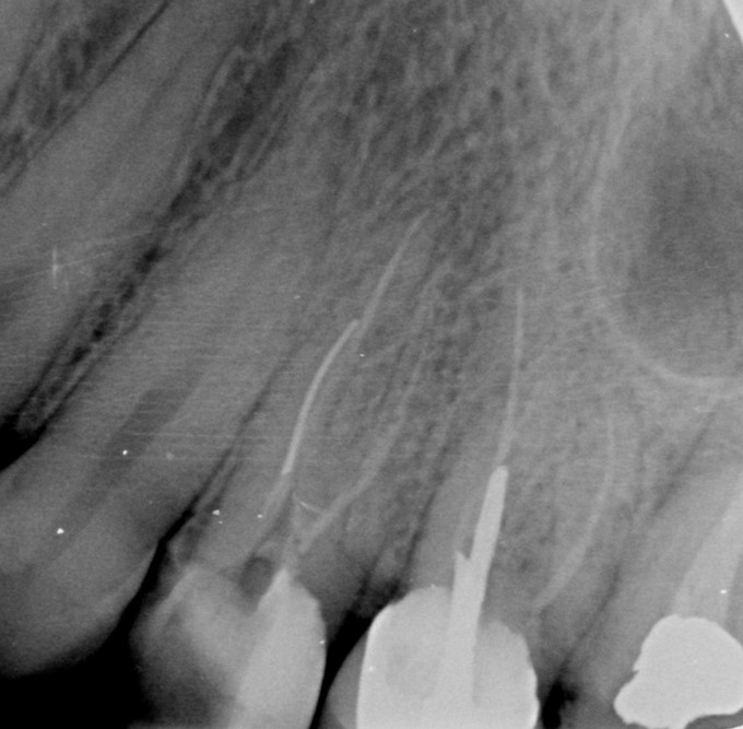 3 year Recall (Importance of Post Endodontic Restoration)